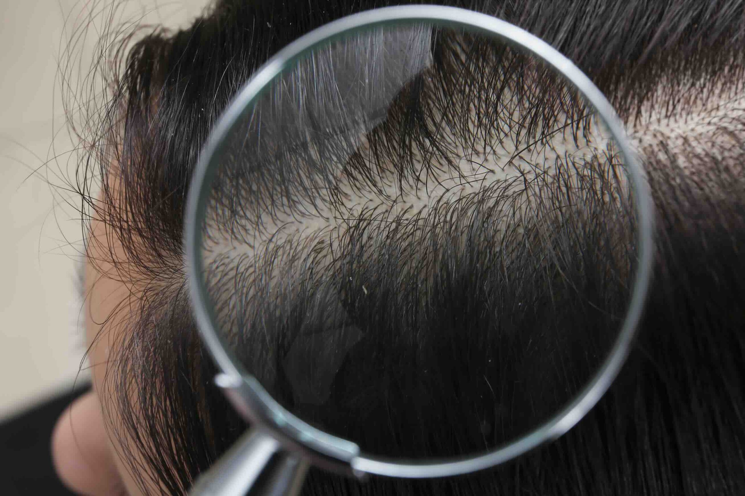 consulenza tricologica roma