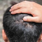 trattamento dermatite psoriasi cute roma