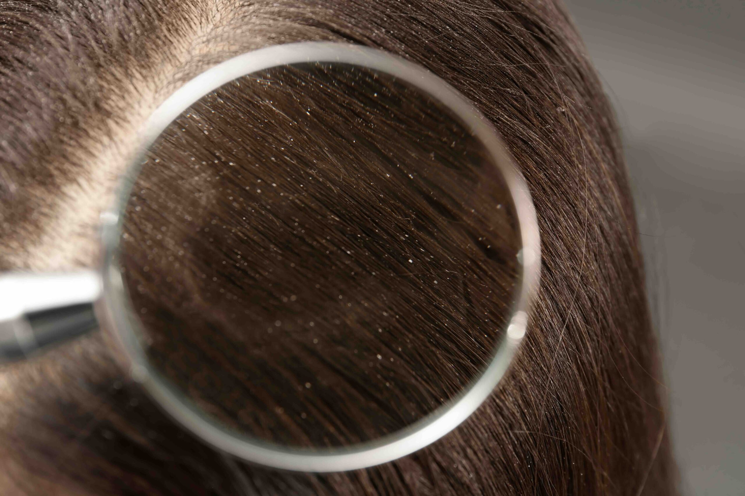 trattamento dermatite psoriasi cute roma
