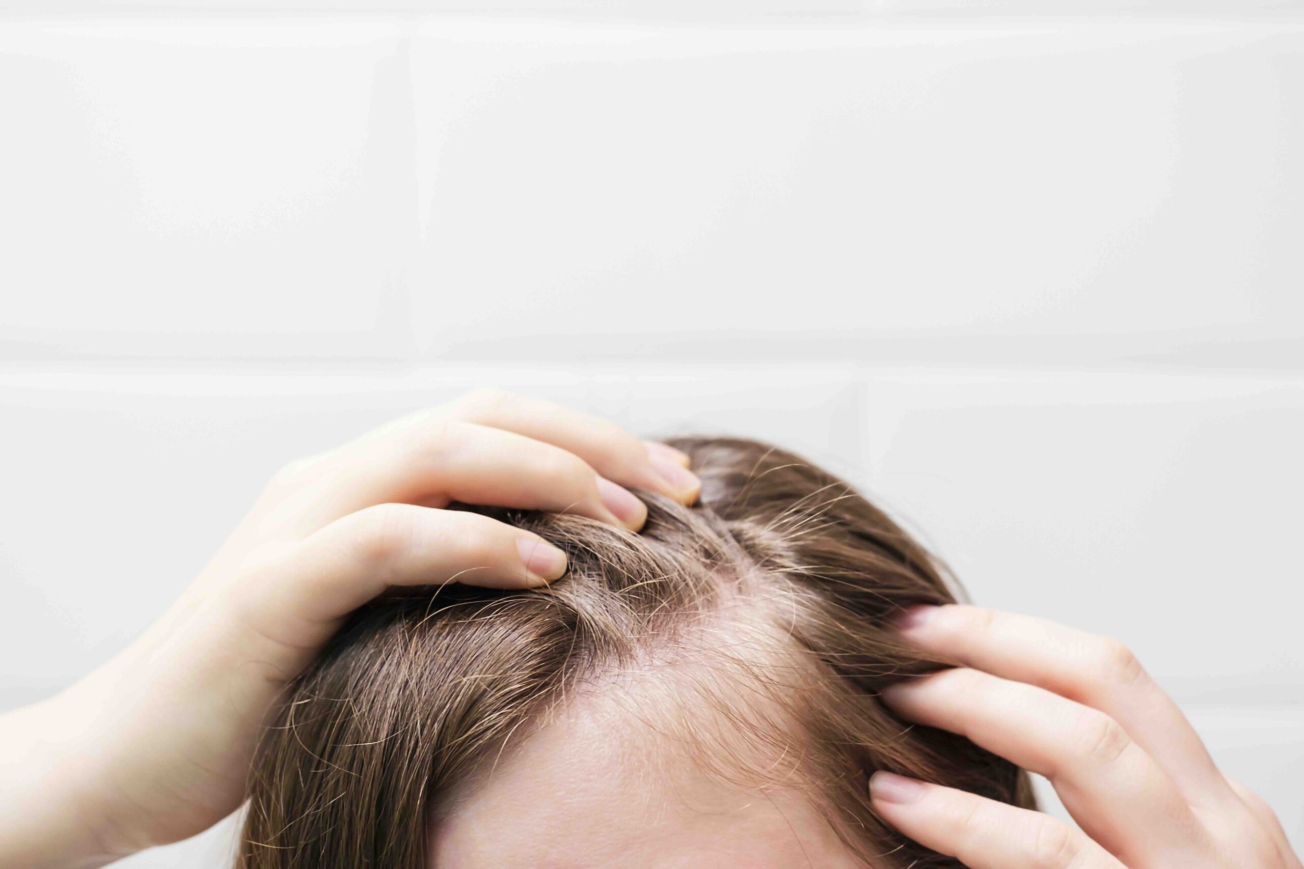 trattamento dermatite psoriasi cute roma