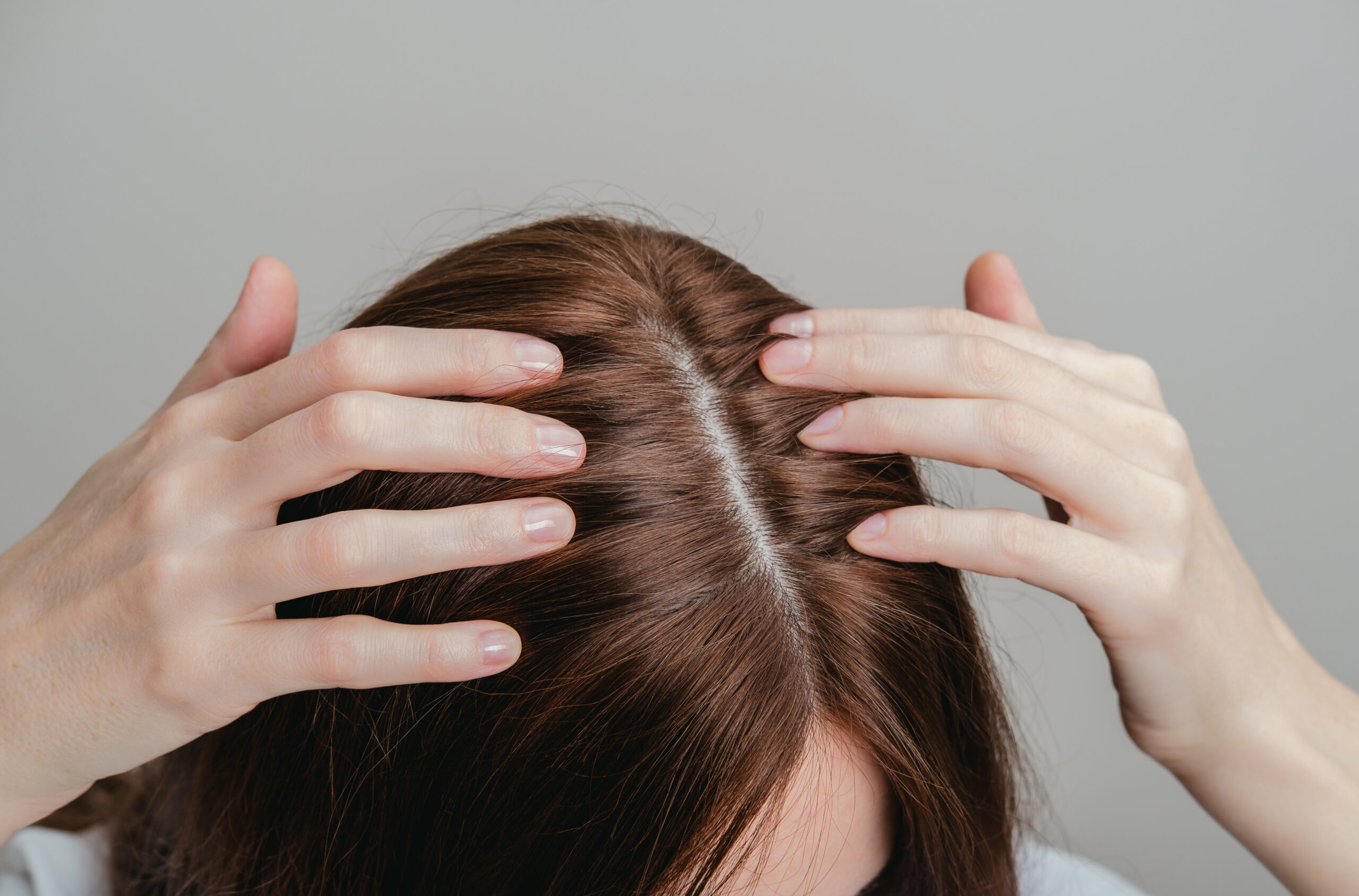 cuoio capelluto, analisi capelli trattamento lenitivo cuoio capelluto roma