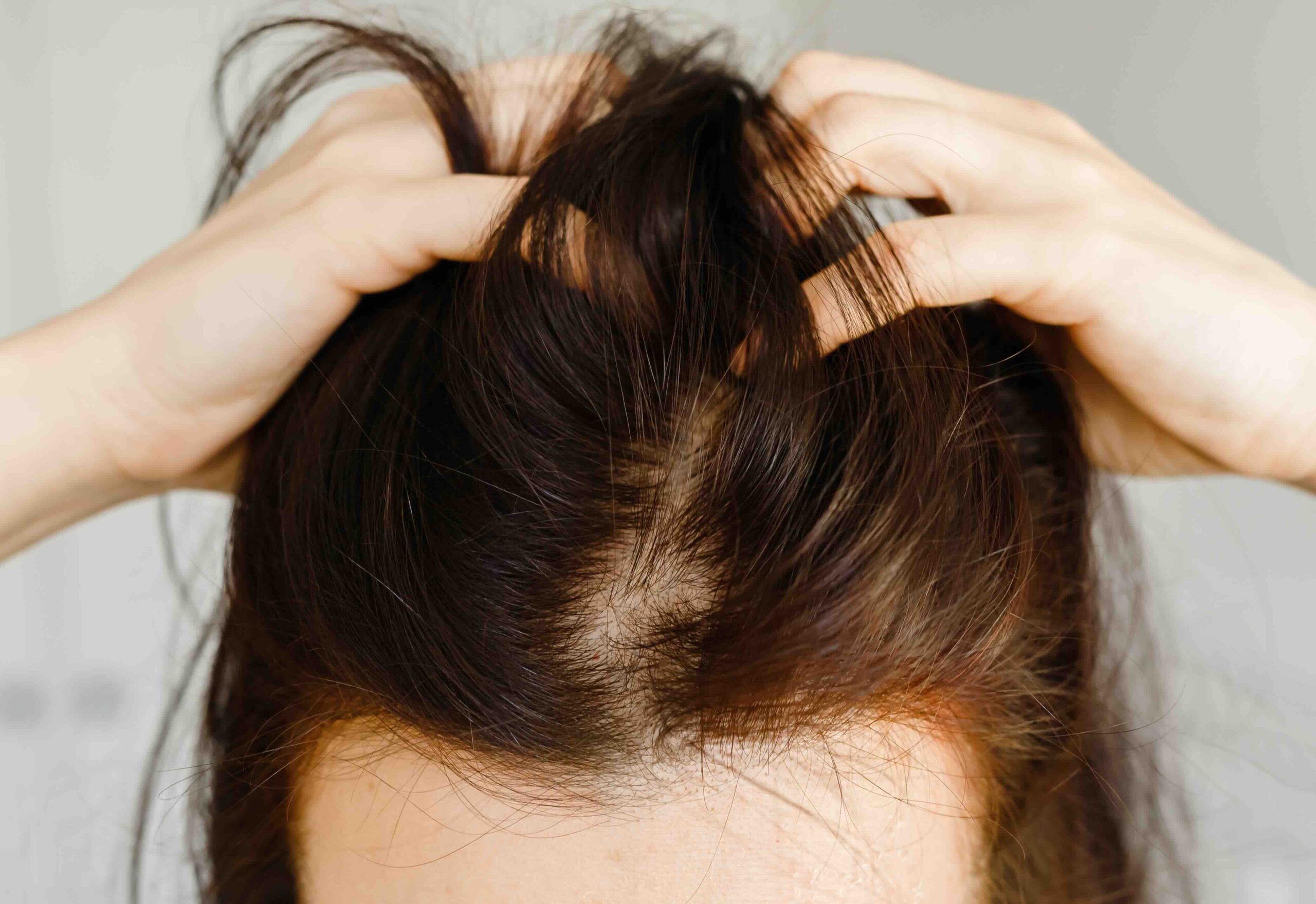 trattamento dermatite psoriasi cute roma